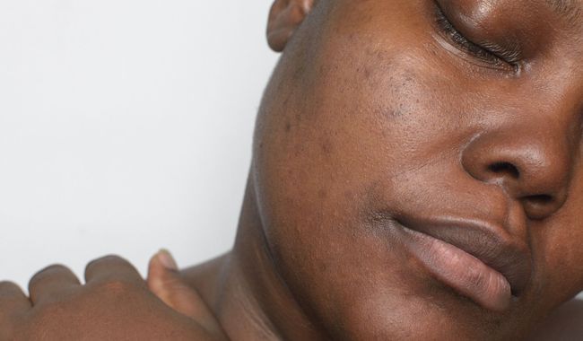 L’hyperpigmentation liée au blanchiment de la peau : causes et solutions